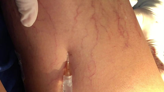 Tratamento Vaicoses